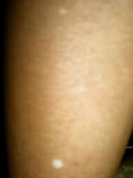Unexplained White Spots On Your Skin This Could Be Why White Skin Spots Age Spot Remedies Skin Spots
