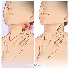 With the exception of the central nervous system (cns), lymph nodes may be found in every area of the body. 3 Rumah Sakit Klinik Dokter Pengobatan Kelenjar Getah Bening Servikal Terbaik Di Malaysia