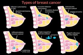 Other than skin cancer, breast cancer is the most common cancer among american women. Supporting Metastatic Breast Cancer Patients During Breast Cancer Awareness Month The Philadelphia Sunday Sun