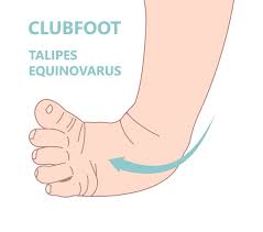 Image result for Clubfoot