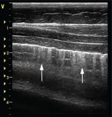 Image result for Rhodococcus equi