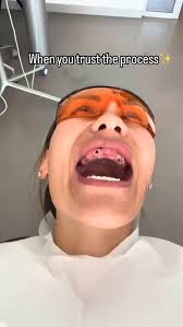 All done😭😭😭😭 Thank you soooo much @verasmile.dental 🥺🥺🥺 You guys  have literally changed my life🥺🥺🥺🥺. #reels #teeth #explorer  #explorepage✨ #instagram #life