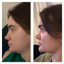 Rhinoplasty in Turkey