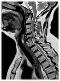 Wirbelsaulenerkrankungen Neurochirurgie In Wiesbaden