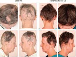 Triamcinolone acetonide (kenalog) is used most commonly; Ilk Index And Regrowth In Alopecia Areata Sciencedirect