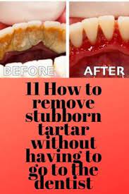 Pin By Love Matthews On Teeth Gum Treatment Healthy Teeth Teeth Health