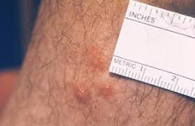 Image result for mite bites on humans