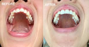 After you have worn the retainer for that period of time, if there is no movement that can be detected, the orthodontist will decide what to do. Is Byte Worth It My Honest Byte Review And Experience W Progress Pictures Subscription Box Expert