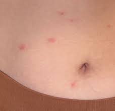 Image result for mite bites on humans