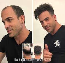 With dozens of respected stylists and treatments to choose from, now you can find the hairstyle you want at a price point you can afford. Hair Replacement For Men Non Surgical Hair Loss System