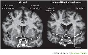 Huntington Disease Nature Reviews Disease Primers