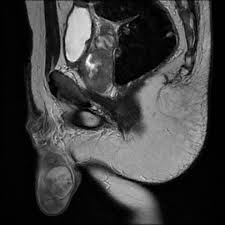 Image result for Genitourinary Tuberculosis