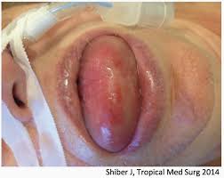 Image result for Angioedema