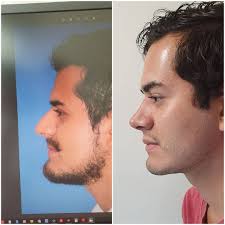 Rinoplastia en hombres siempre es un reto! Excelente resultado a 14 días de  la cirugía. Dr. Jesús Báez Márquez. Centro Médico Puerta de Hierro Andares  piso 23 consultorio2305 . Citas de valoración