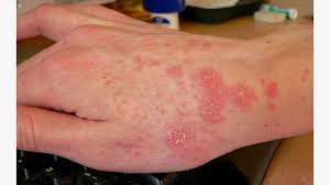 Image result for human scabies