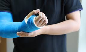 Image result for Long Arm Cast