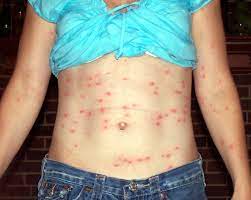 Chigger Bites Symptoms Treatments Prevention Health Com