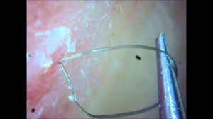 Check spelling or type a new query. Ingrown Hair The Longest Ingrown Hair