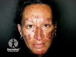 Image result for Connective Tissue Disorder