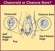 Chancroid Sexinfo Online