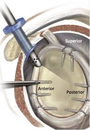 Can a shoulder labral tear heal without surgery? Graphic Of The Left Shoulder Demonstrating Circumferential Repair Of Download Scientific Diagram