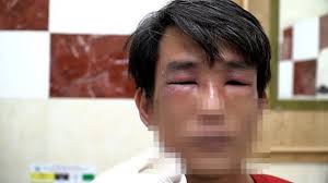 TP HCM: Kiến ba khoang tấn công, nhiều người nhập viện do tự chữa trị sai  cách