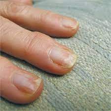Prevent Nail Damage With Proper Gel Polish Removal Gel Nails French Gel Polish White Spots On Nails