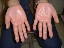 Visit Our Site Http Www No Ets Com For More Information On Hyperhidrosis Hyperhidrosis Causes The Hyperhidrosis Excessive Underarm Sweating Sweating Too Much
