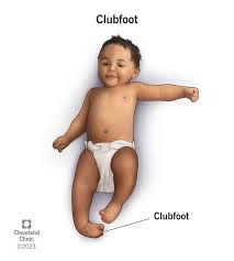 Image result for Clubfoot
