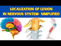 Image result for Neurologic Lesion Localization