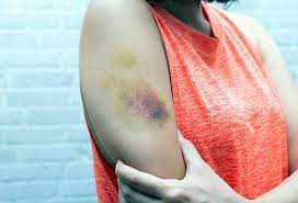What Will Make Bruises Go Away Fast?