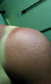Check spelling or type a new query. What Sun Poisoning Looks Like Album On Imgur