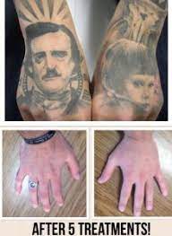 The next section of the website is about what you can do to prevent tattoo infections. Can You Have Tattoos In The Military Medermis Laser Clinic