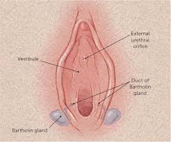 Image result for Bartholin's gland abscess