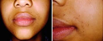 Atlas of Dermatological Manifestations in Gastrointestinal Disease