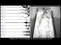 Image result for REM Sleep Behavior Disorder