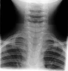 Image result for Croup