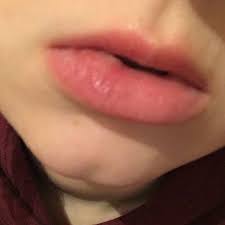 Die erste maßnahme sollte also kühlung sein. Geschwollene Lippe Durch Apfel Allergie Angeschwollen Gebissen