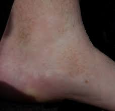 Image result for Pigment stains on the shin