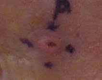 There are several types of carcinomas with different levels of severity. Squamous Cell Carcinoma Wikipedia
