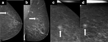 Lobular carcinoma) are more difficult to detect than. Lobular Breast Cancer Series Imaging Breast Cancer Research Full Text