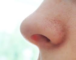 Paula's choice calm redness relief. Rosacea