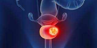 Bladder (Urinary Bladder) Cancer - Urocore