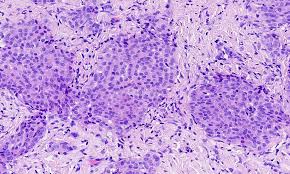 Desmoplastic mesothelioma is a rare variant of malignant mesothelioma with a storiform collagen pattern, collagen necrosis, bland acellular collagen and focal cytological features of malignancy. Pathology Outlines Mesothelioma Pleura Epithelioid
