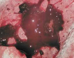 It will take about four to eight weeks for your regular period to return. Miscarriage Or Blood Clot Grief Loss Forums What To Expect