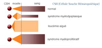 Le traitement de la leucémie aiguë cherche à détruire les cellules leucémiques afin que la moelle osseuse puisse à nouveau. Infocancer Arcagy Gineco Les Localisations Hemopathies Malignes Cancers Du Sang Syndromes Myeloides Les Syndromes Myelodysplasiques Smd
