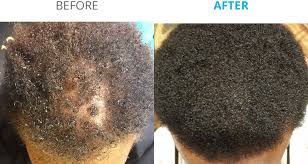 And a review published in 2017 in the journal of the american academy of dermatology (aad) found that men using the topical twice daily had an average increase of nearly 15 hairs per square. Index