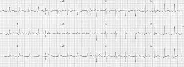Solitamente i tempi di guarigione sono brevi, circa sei settimane, e in rarissimi casi la pericardite. Pericarditis Ecg Changes Litfl Ecg Library Diagnosis
