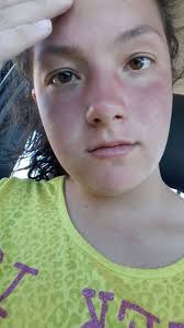 Has anyone had an odd gait due to lupus?