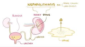 Kidney Stones